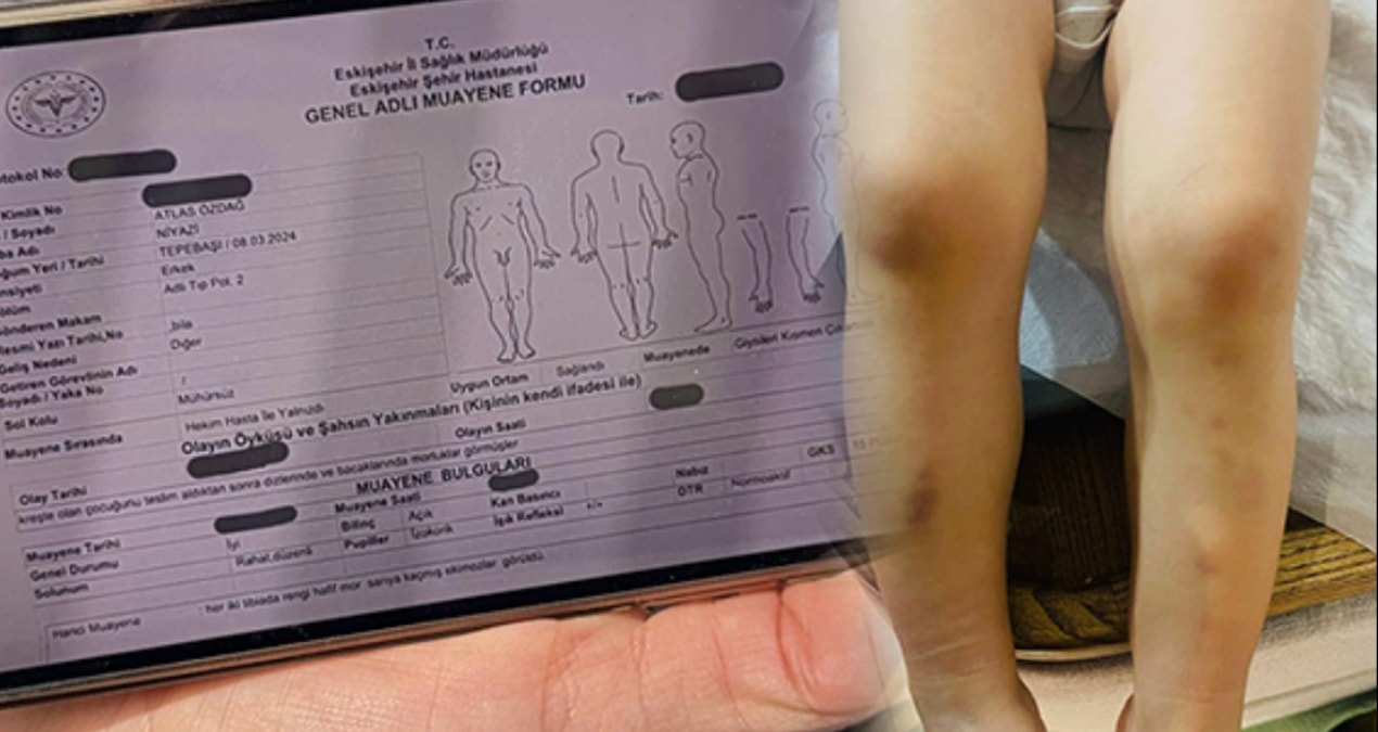 2 yaşındaki Atlas'ın kreş kabusu: Vücudundaki morlukları gören annesi savcılığa koştu - En Son Haber ve Merak