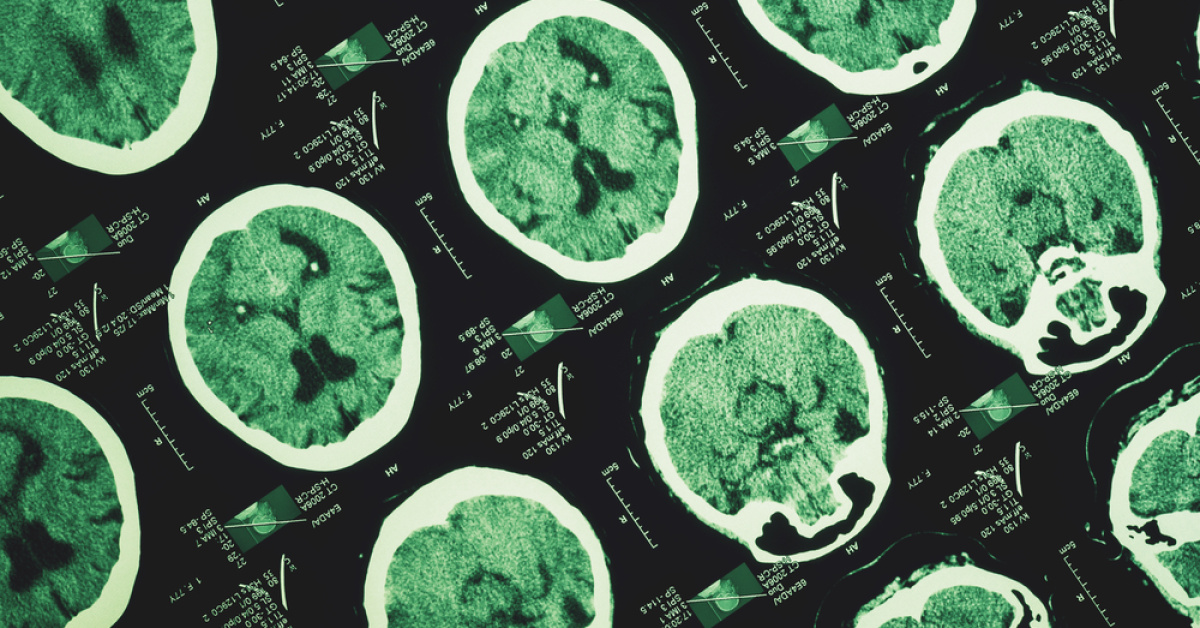 Gündemden Son Bilgiler: Alzheimer unutkanlıkla başlamıyor: Gelişmeler Takip Ediliyor
