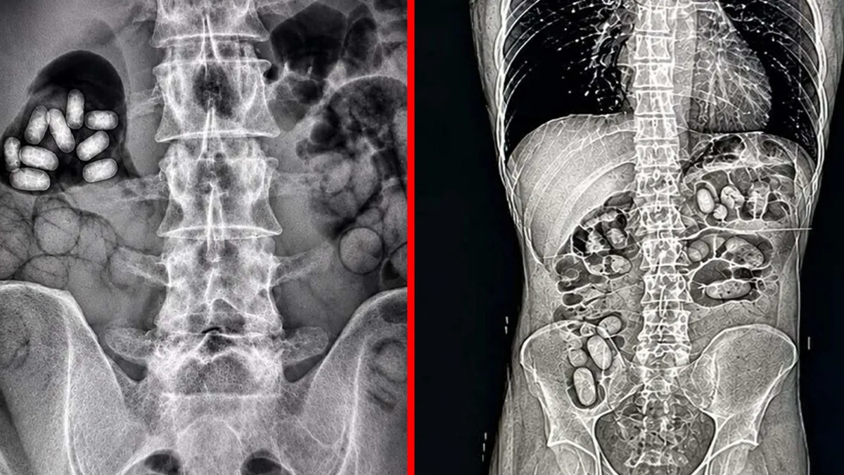 Gündemden Son Bilgiler: Sağlık kontrolünde gözler önüne serildi: İki yolcunun midesinden 60 kapsül metamfetami