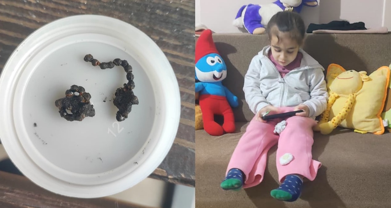 Gündemden Son Bilgiler: Hastane yetkilileri sessiz! 5 yaşındaki Polen, 2 yıldır burnunda tırnak makası zinciri