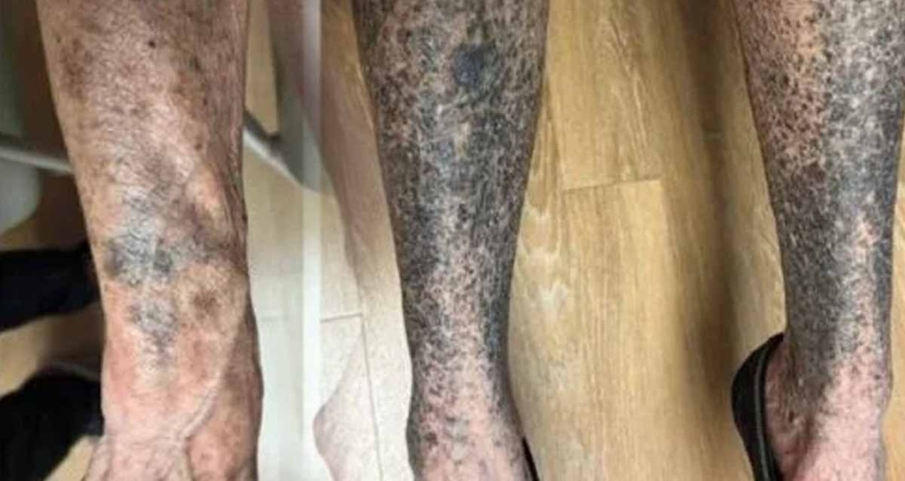 İçtiği ilaçtan sadece 14 gün sonra koları, bacakları masmavi oldu - En Son Haber - Son Dakika Bilgileri