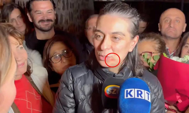 Sinem Dedetaş'ın dudağının kenarındaki kızarıklığın nedeni netlik kazandı: Gelişmeler Takip Ediliyor