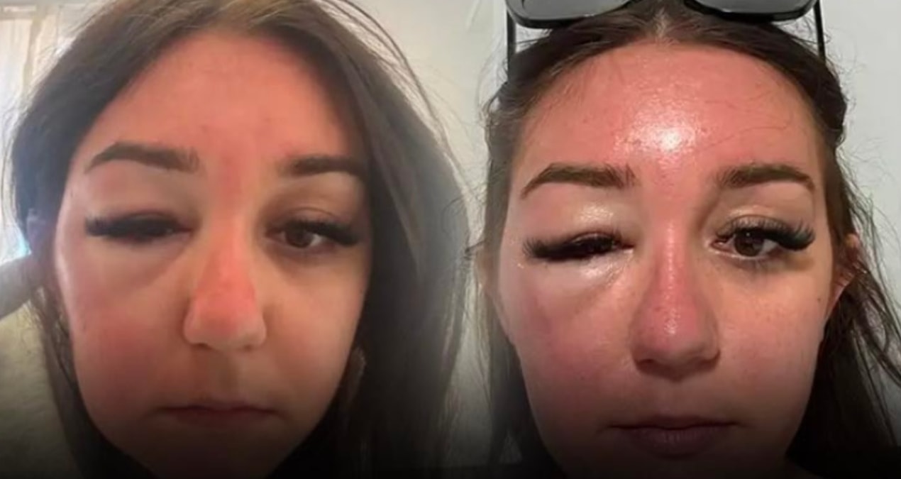 He experienced a nightmare on holiday: His face became unrecognizable - Breaking News