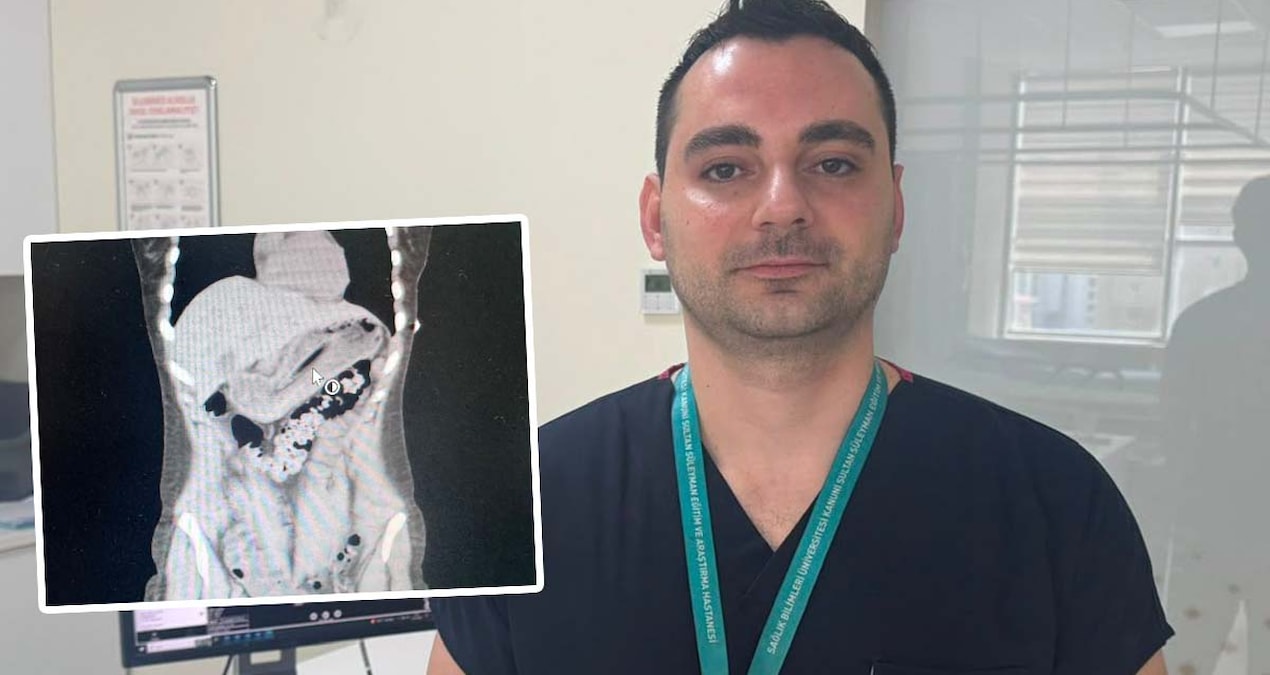 He swallowed a 13-centimeter toothbrush while trying to lose weight: Even doctors were surprised - Breaking News